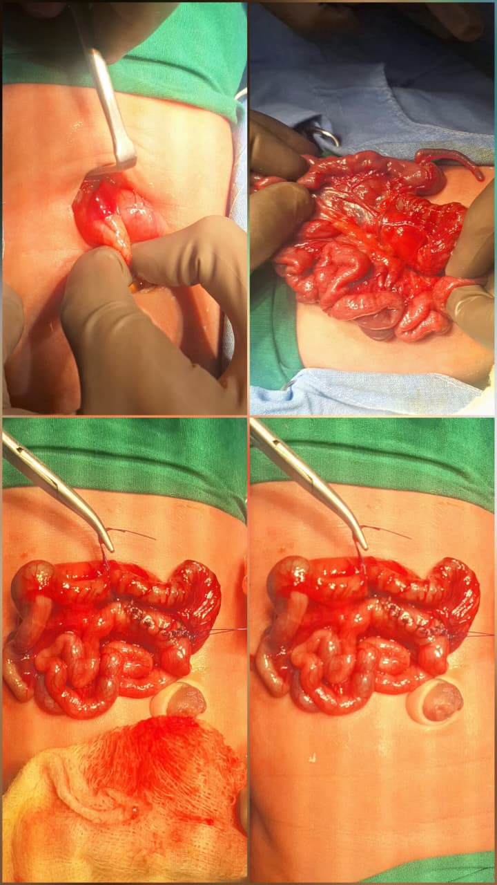 Gastro-Jejunostomy for Duodenal atresia