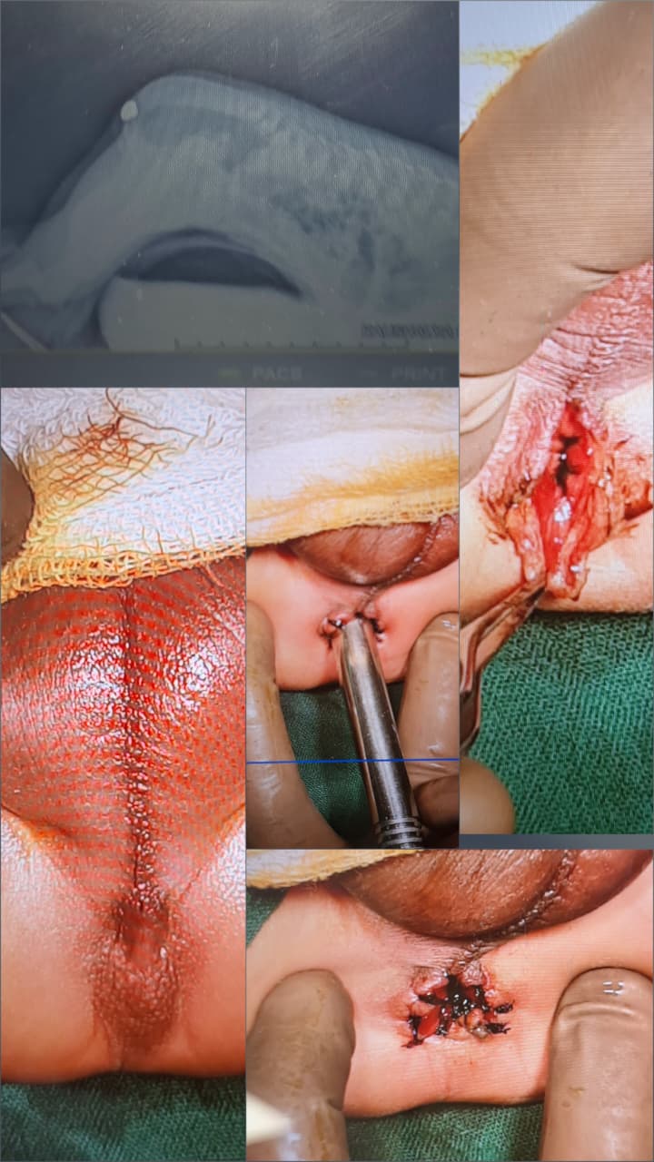 Y-V Anoplasty for Imperforate Anus (Low ARM)